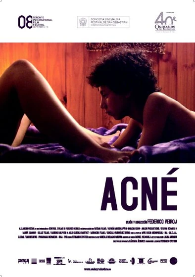 Imagen de acne (Cartel)
