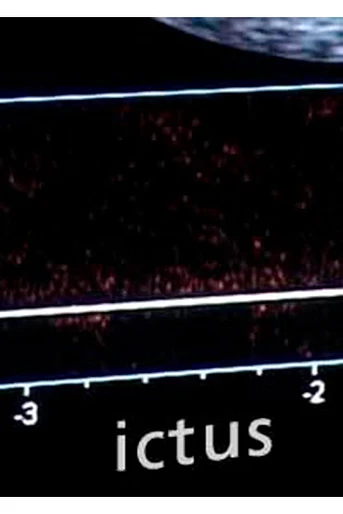 Poster de Ictus